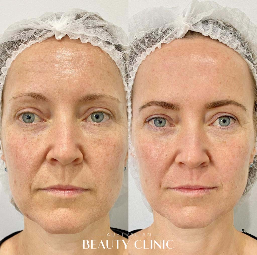 Hifu Before and after HIFU Facial image with actual results of people