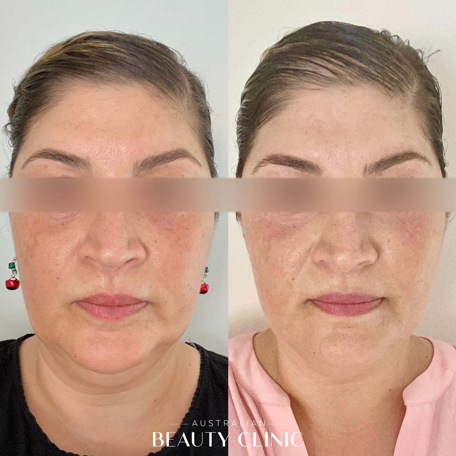 Before and after HIFU Facial, image showing skin tightening on face and neck area with actual result of a client