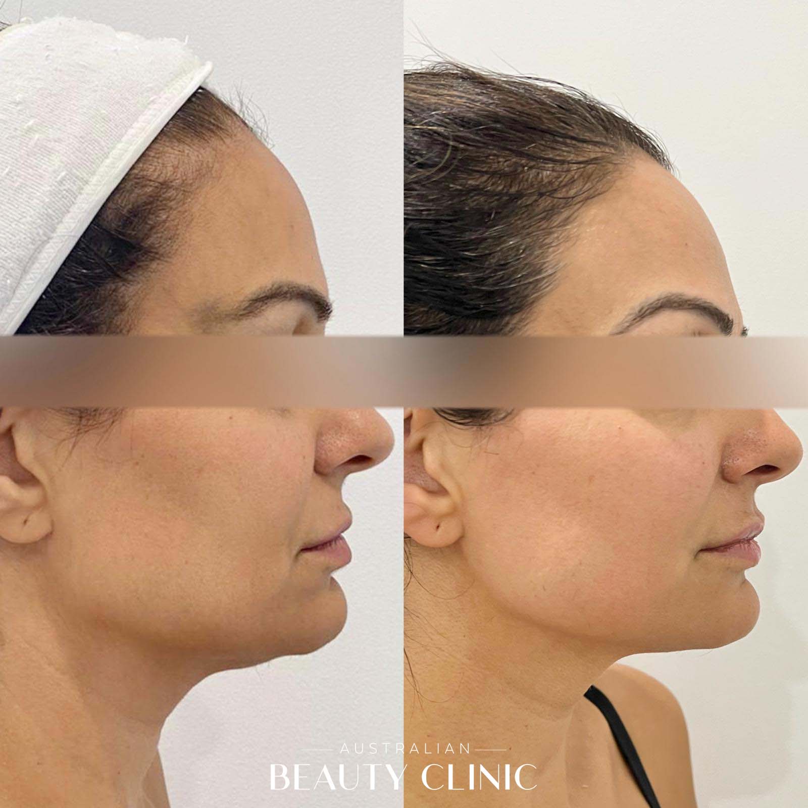 Hifu Before and after image with actual results of people