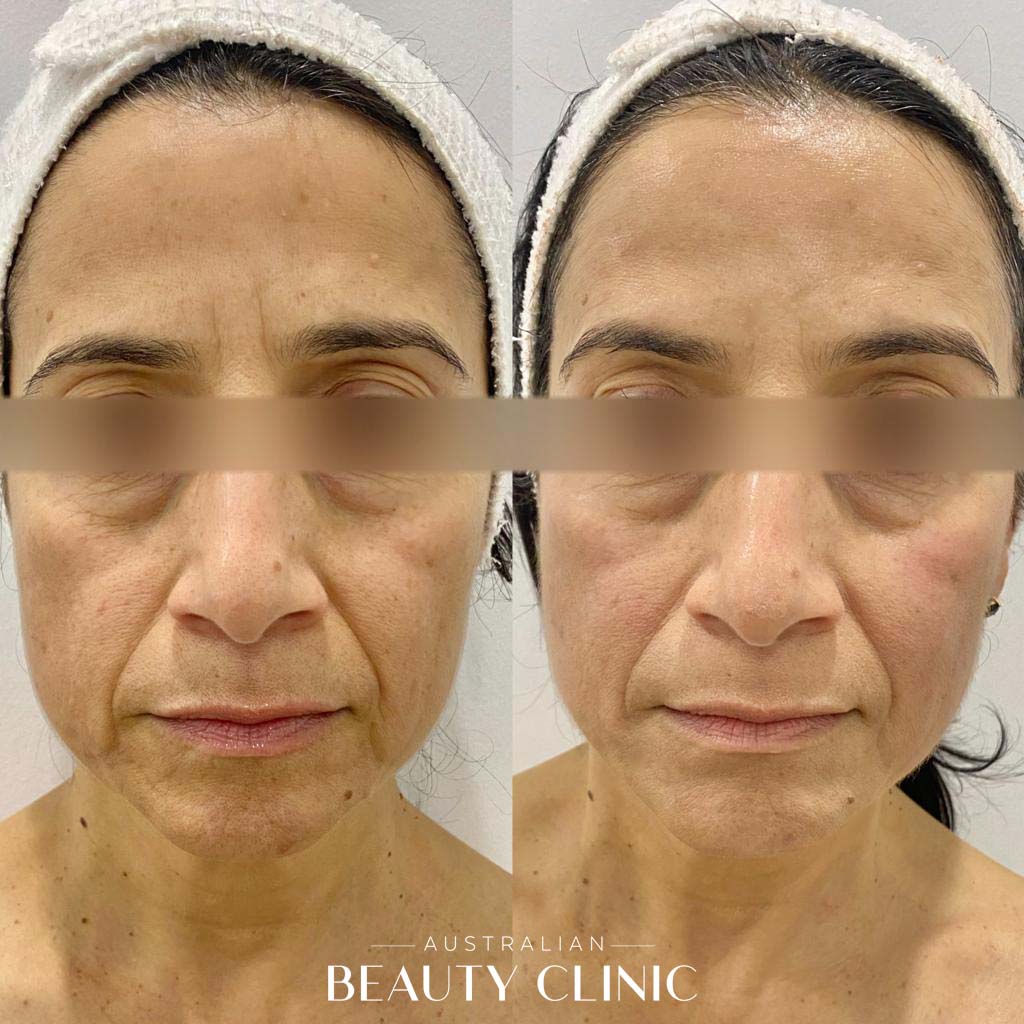 Hifu Before and after HIFU Facial image with actual results of people