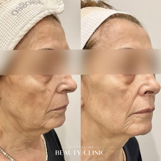 Hifu Before and after HIFU Facial image with actual results of people