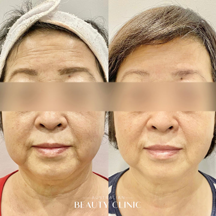 Hifu Before and after HIFU Facial image with actual results of people