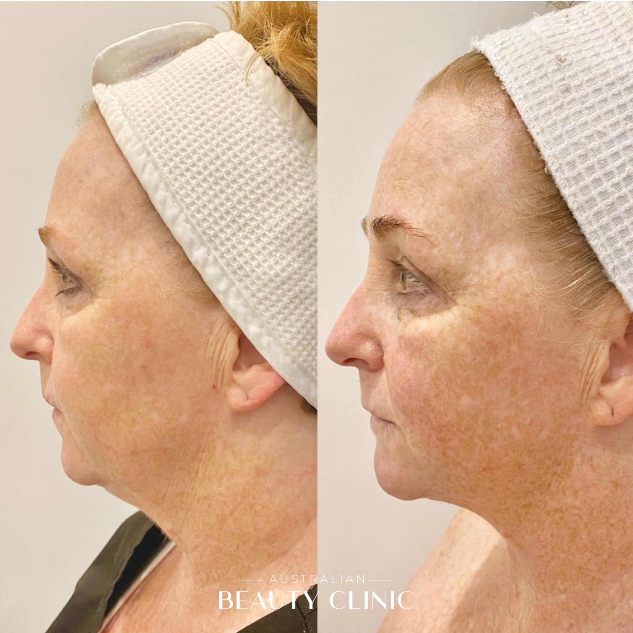 Hifu Before and after HIFU Facial image with actual results of people