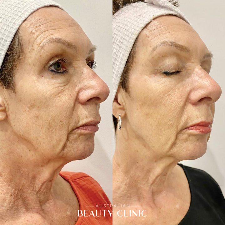 Before and after HIFU Facial, image showing skin tightening of face and neck with actual result of a client