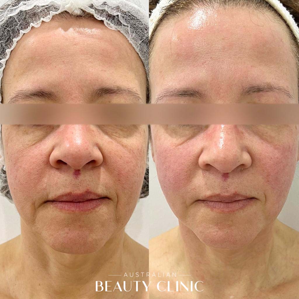 Hifu Before and after HIFU Facial image with actual results of people