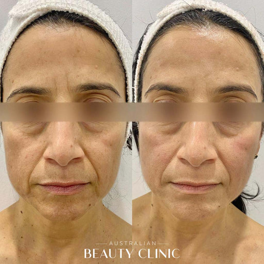 Hifu Before and after HIFU Facial image with actual results of people