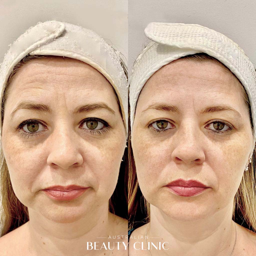 Hifu Before and after HIFU Facial image with actual results of people