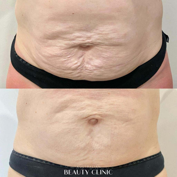 Before and after HIFU Body, image showing skin tightening of belly area with actual result of a client