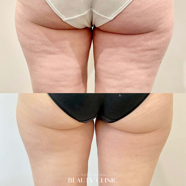 Before and after HIFU Body, image showing skin tightening of buttocks area, with actual result from a client